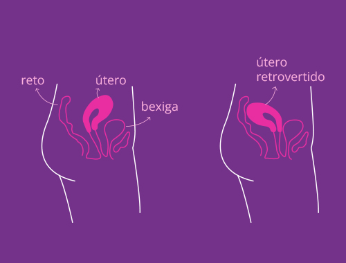 Como o útero retrovertido pode afetar a sua saúde e o prazer?